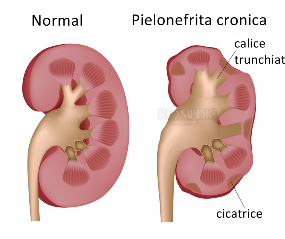  Pielonefrita cronica - manifestari, diagnostic, tratament, complicatii
