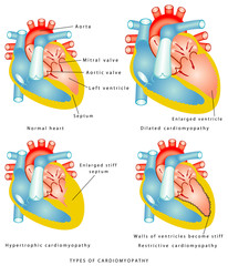  Hipertrofia cardiaca – diagnostic și tratament