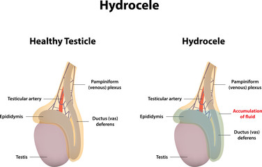  Hidrocelul- diagnostic și tratament