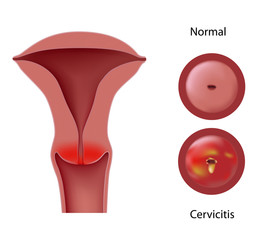  Cervicita – inflamaţia colului uterin