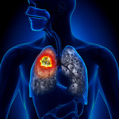  Cancerul bronhopulmonar- de la simptome, diagnostic și tratament