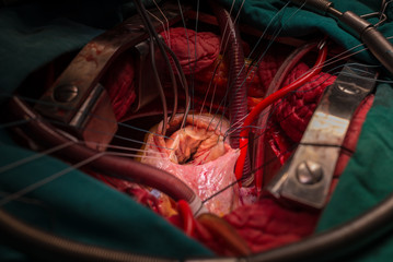  Defect septal ventricular