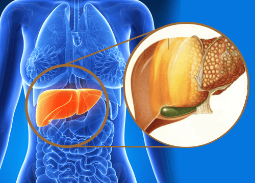  Ciroza hepatică: cauze, diagnostic și tratament
