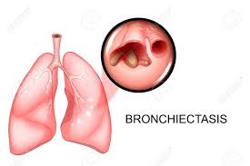  Bronşiectazia: ce este, care sunt simptomele, cum o tratăm