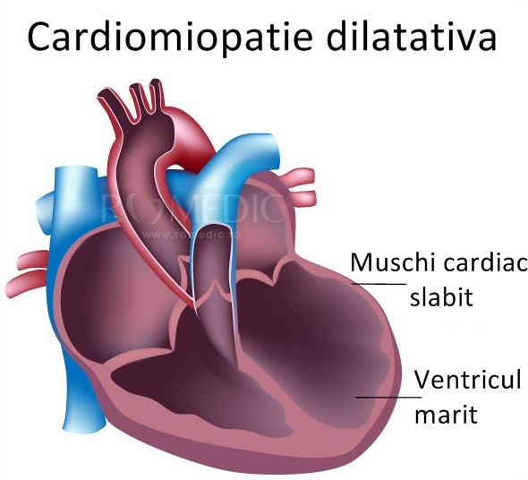  Cardiomiopatia dilatativa - cauze, diagnostic, tratament