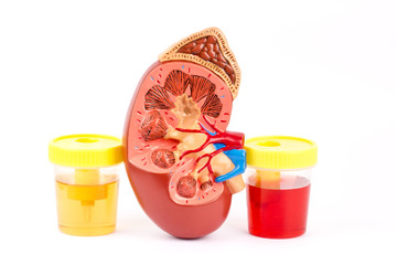  Hematuria (sânge în urină): cauze, investigații și diagnostic