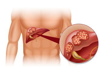  Cancerul hepatic (Carcinomul hepatocelular)