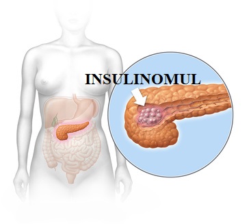  Insulinomul – diagnostic și tratament