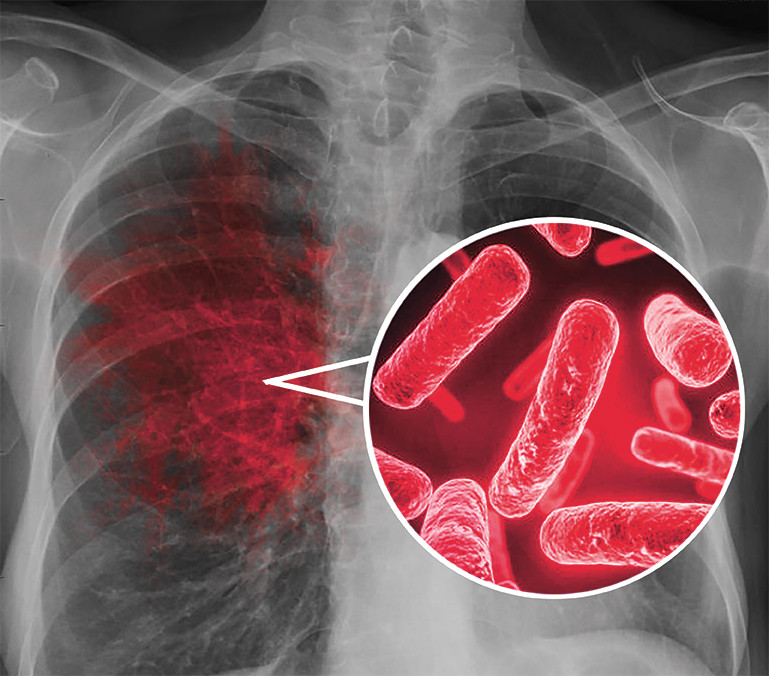  Tuberculoza multidrog rezistentă – de ce apare și cum se tratează