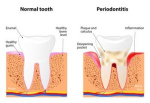 parodontita