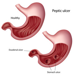 Stomac sănătos versus stomac cu ulcer gastroduodenal