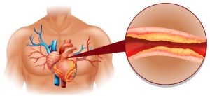 Depunerea colesterolului la nivelul cordului și vaselor de sânge