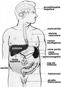 varicoză cu boală hepatică)