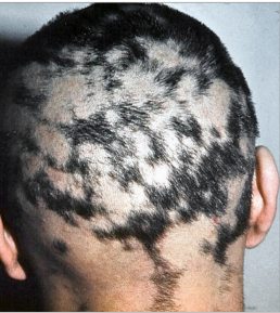 Alopecia in sifilis