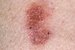 Dermatoza Tipuri Simptome Tratament Dermatoze Precanceroase