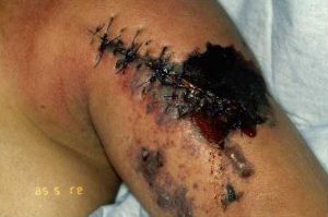 Infecțiile cutanate - Aspect de gangrenă gazoasă