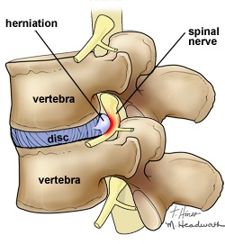 tratamentul coloanei vertebrale l durere în articulațiile picioarelor când se mișcă