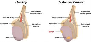 Tumorile testiculare - Reprezentare comparativa intre testiculul sanatos si cel afectat tumoral