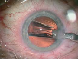 transplantul de cornee restabilește vederea tratamentul vederii cu laser