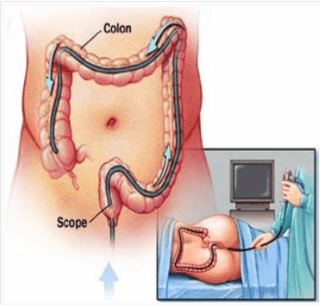  Endoscopia digestivă inferioară - pregătire și tehnică