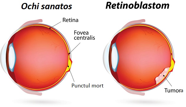  Retinoblastomul -tumoră malignă a ochiului