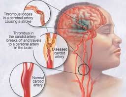 Arterita temporală (arterita cu celule gigant, arterita craniană sau boala Horton)