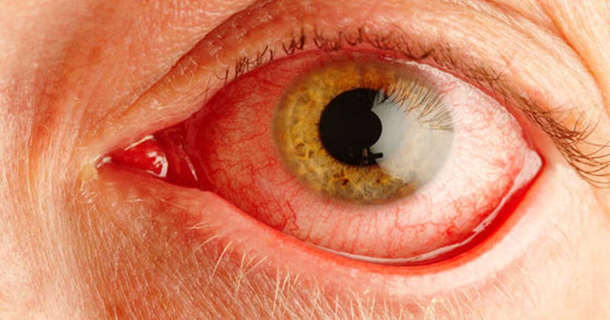  Sindromul de ochi uscat- ce este, cauze și tratament