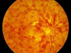 Ocluzia vasculara retiniană: cauze, simptome, tratament