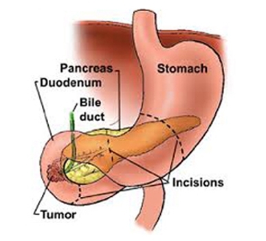 cancer duodenal simptome