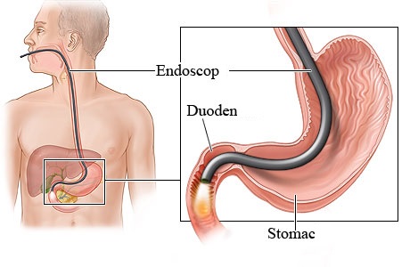 Ulcer duodenal simptome