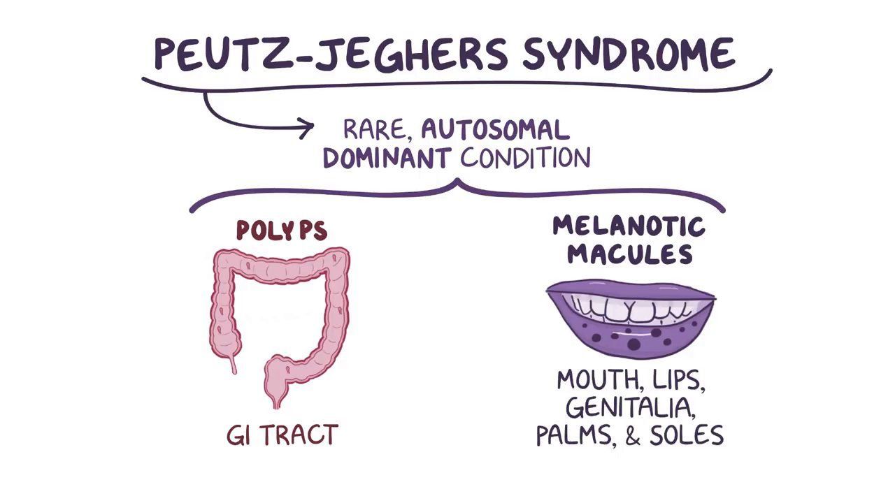  Sindromul Peutz-Jeghers- tablou clinic, tratament