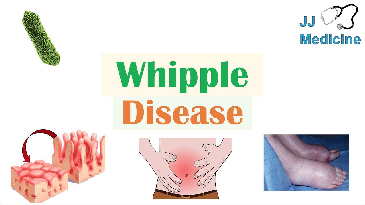  Boala Whipple- semne, simptome și tratament
