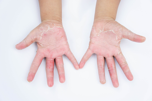 Dermatita de contact: Cauze - Simptome - Tratament