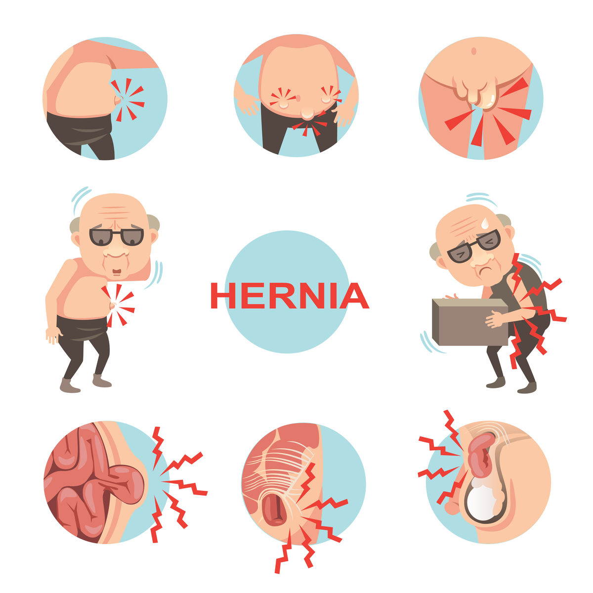  Hernia inghinala – simptome si tratament