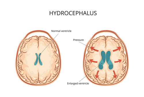  Hidrocefalia – cauze, simptome, tratament