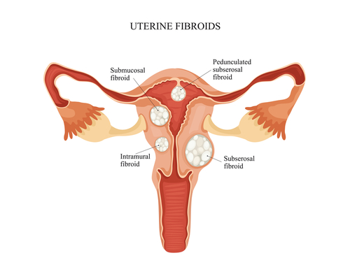  Fibromul uterin – cauze, evolutie, tratament