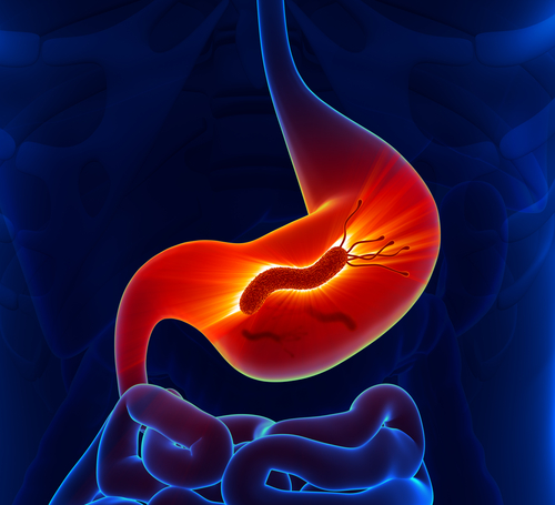 tratamentul varicozei în timpul gastritei