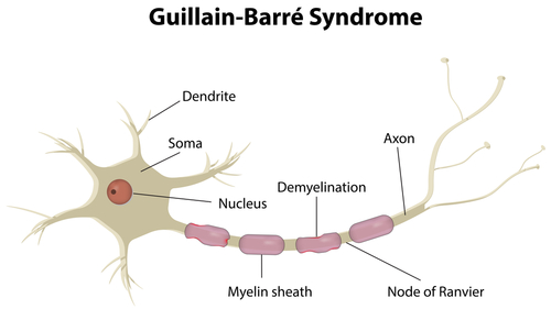  Sindromul Guillain Barre-cauze, simptome, diagnostic