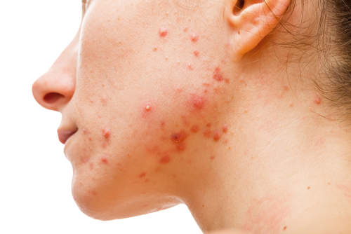  Acneea-tipuri de acnee, tratamentul acneei