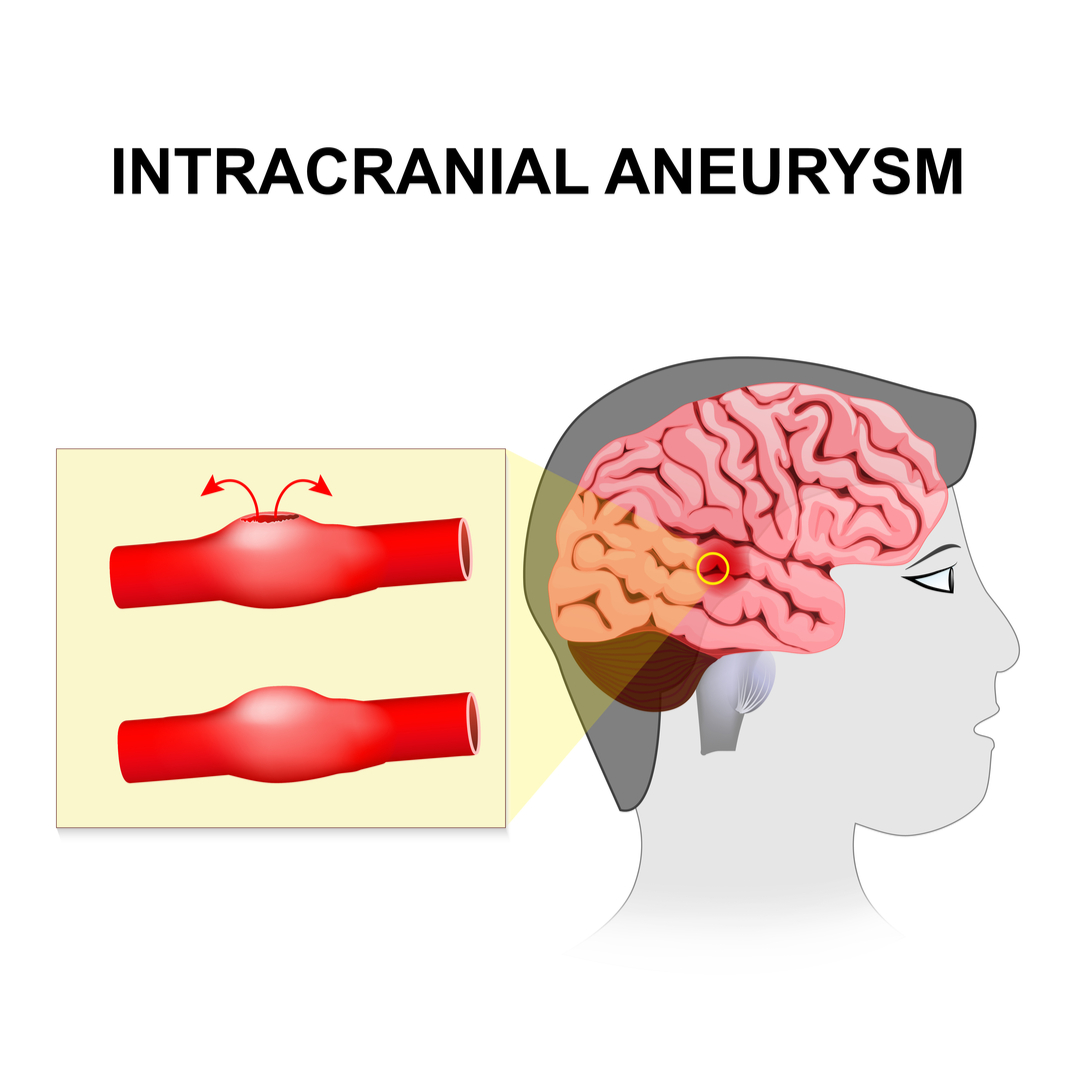  Anevrism intracranian – cauze, simptome, tratament