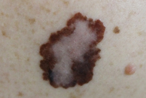  Cancerul de piele-Expunerea la soare si cancerul de piele