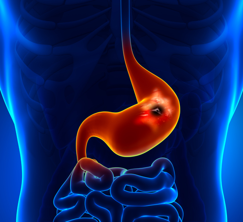 Cancerul de stomac – depistat adesea in stadii avansate | kozossegikartya.ro