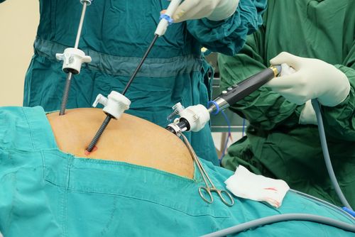  Colecistectomia-tehnica laparoscopică