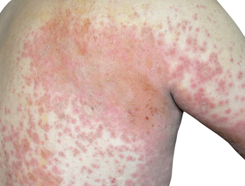  Dermatita atopica-cauze și tratament