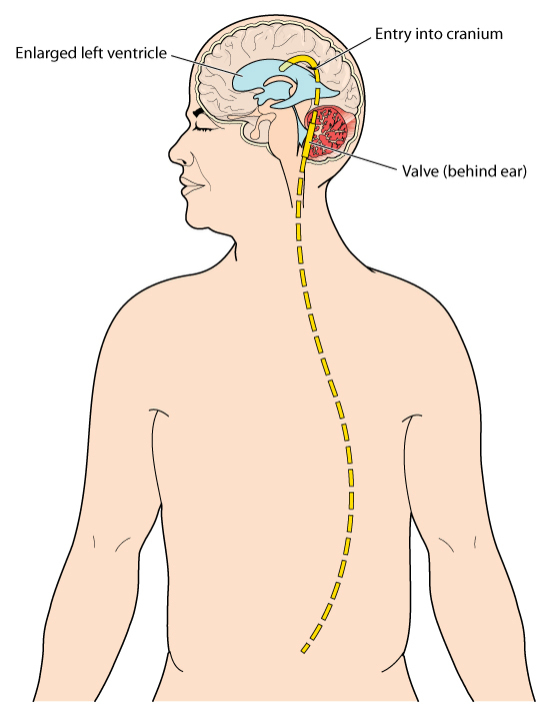  Drenajul ventriculo-peritoneal