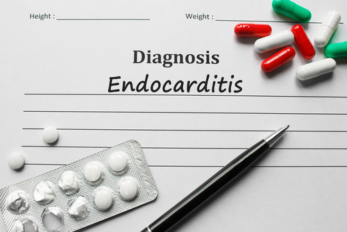  Endocardita infectioasa – cauze și factori de risc