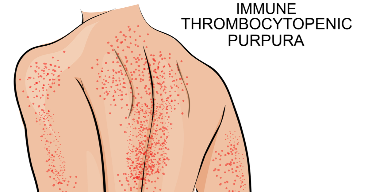  Purpura trombocitopenica imună – generalităţi şi tratament