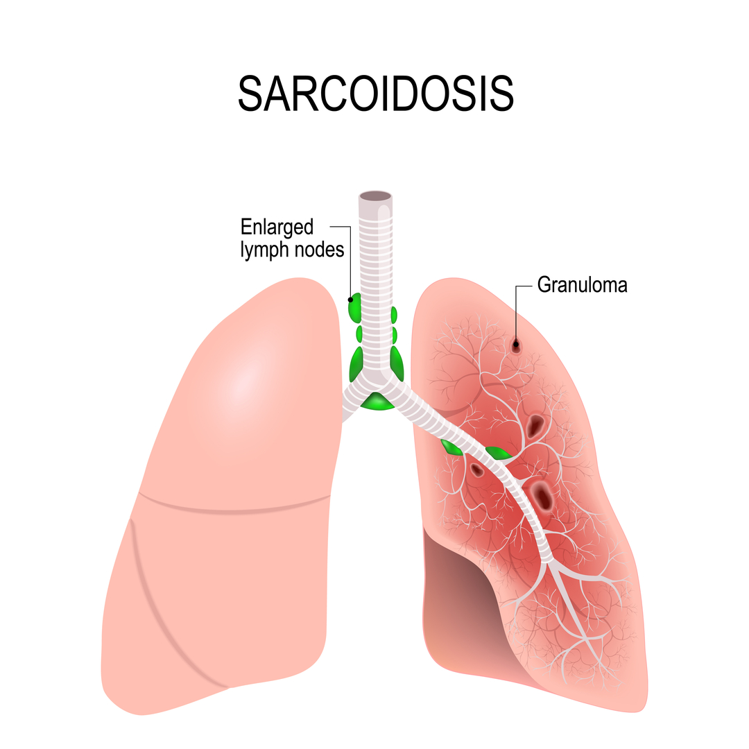  Sarcoidoza pulmonară- diagnostic și tratament