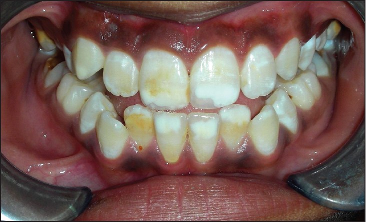  Sindromul de hipomineralizare molar-incisiv (MIH)