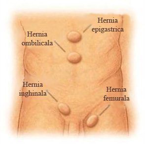  Hernia abdominală